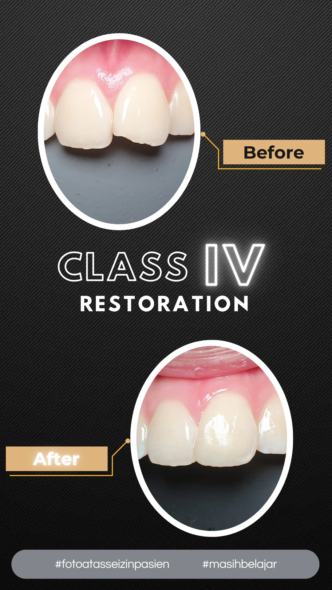 Poster design titled Class IV Restoration